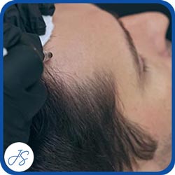 Scalp Micropigmentation Near Me in Middleburg Heights, OH